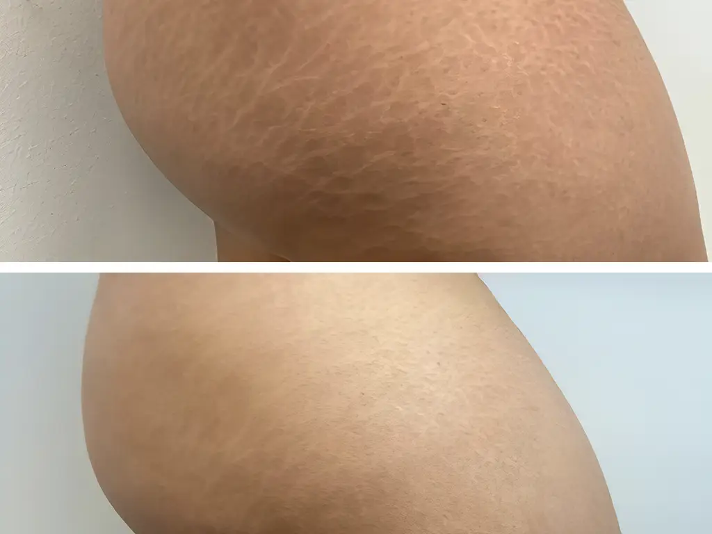 A stretch mark camouflage treatment showing before and after results in Eagle Mountain.